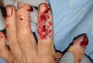 指の外傷性組織欠損に対する穿通枝皮弁術による再建1