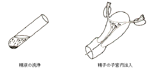 人工授精の図