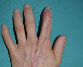 指の外傷性組織欠損に対する穿通枝皮弁術による再建2