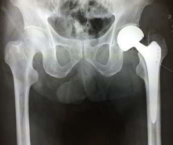 大腿骨頸部骨折に対する人工骨頭置換術1