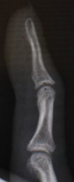 骨性マレット指に対する手術療法3