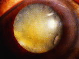 白内障の眼の写真