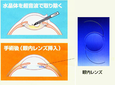 白内障の手術方法